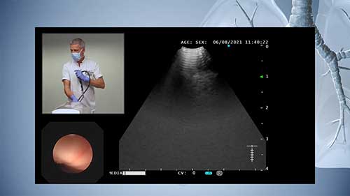 经气管镜超声引导针吸活检操作演示