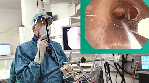 鞘管引导的经支气管冷冻活检