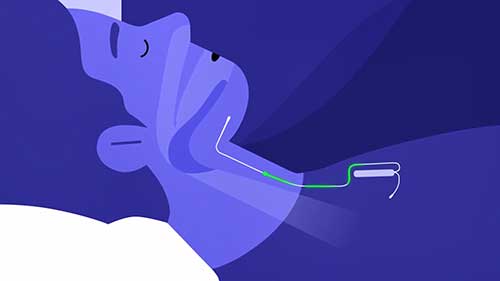 睡眠呼吸暂停的新疗法