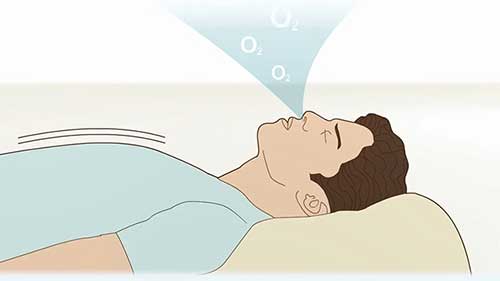 了解阻塞性睡眠呼吸暂停综合征