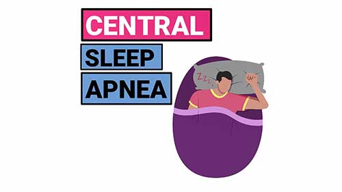 中枢性睡眠呼吸暂停