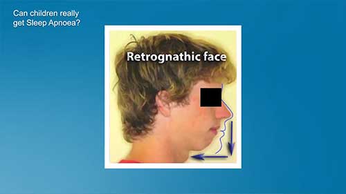 儿童阻塞性睡眠呼吸暂停概述