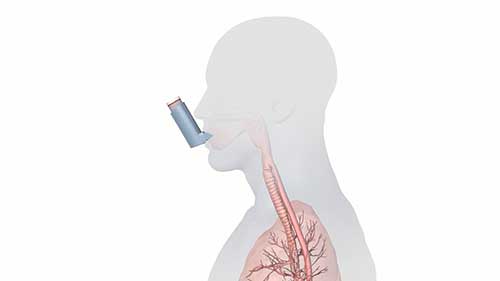 慢性阻塞性肺疾病的症状与治疗