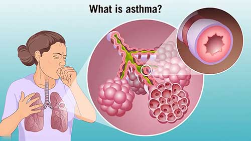 哮喘严重程度分级