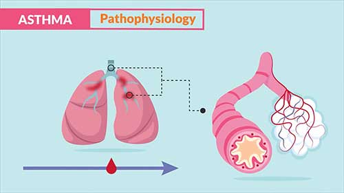 哮喘病理生理学