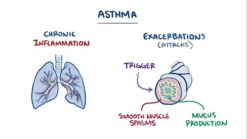 哮喘的诊断与治疗