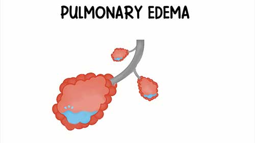 肺水肿简要介绍