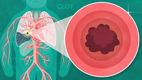 肺栓塞基础知识