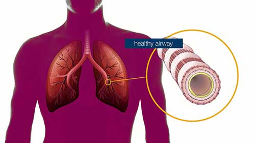 什么是支气管扩张