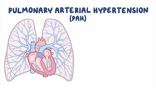 肺动脉高压概述