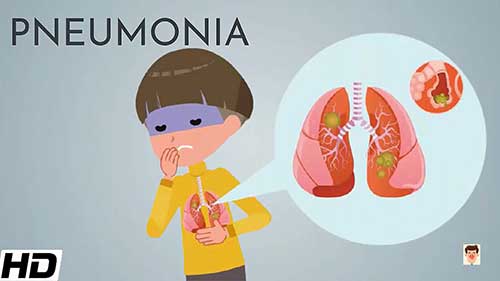 关于肺炎，你需要知道的知识