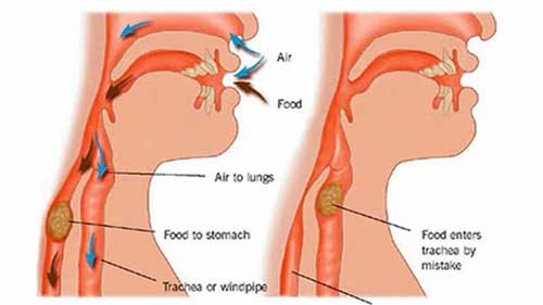 吸入性肺炎的厌氧菌覆盖