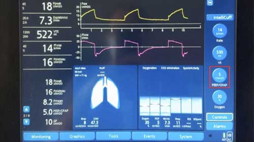 急性呼吸衰竭讲座