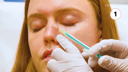 受欢迎的半侵入式美容疗法