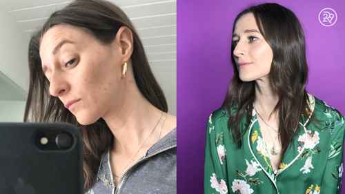 微针祛除痤疮疤痕