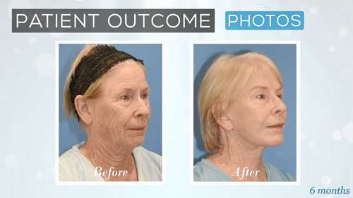 女性面部年轻化案例分析