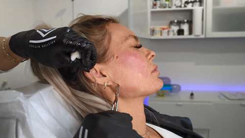 面部埋线提升术