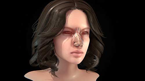 鼻整形术适应症和流程