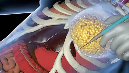 隆胸手术是如何进行的