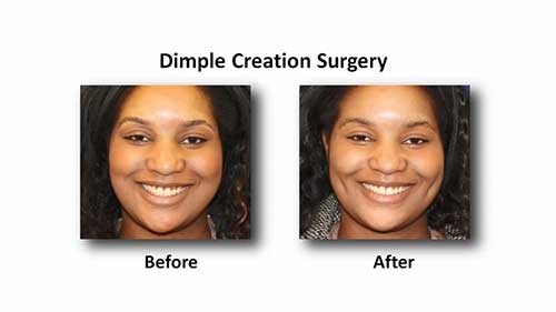 酒窝成形术可以维持多久