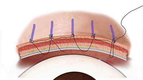非切口双眼皮手术动画展示