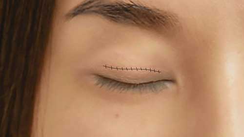 亚洲眼睑成形术动画展示