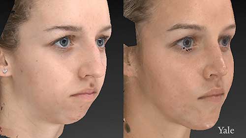 面部整形手术的新前沿