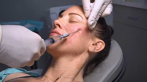 面部自体脂肪填充