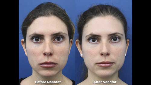 纳米脂肪移植面部年轻化