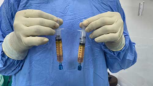 自体脂肪移植治疗痤疮瘢痕