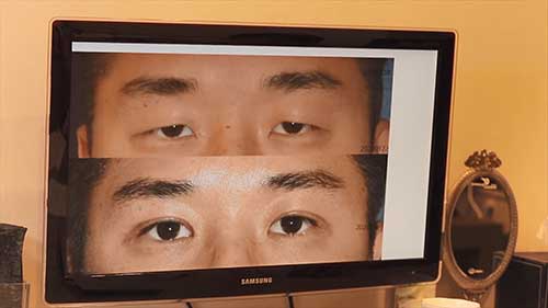 内眦赘皮整形手术