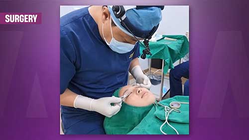 韩国开眼角手术体验