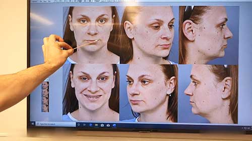 唇部提升术实践