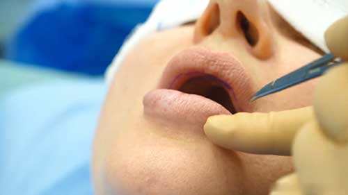 唇部缩小手术实践