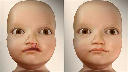 唇裂修复手术标记