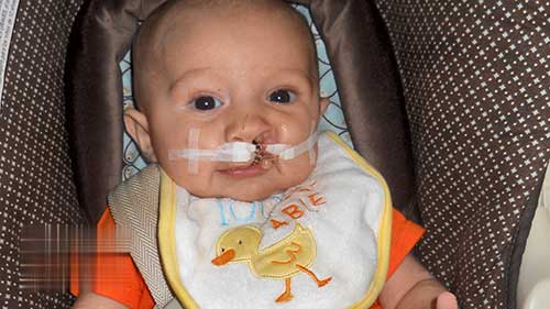 唇腭裂：鼻槽牙塑形