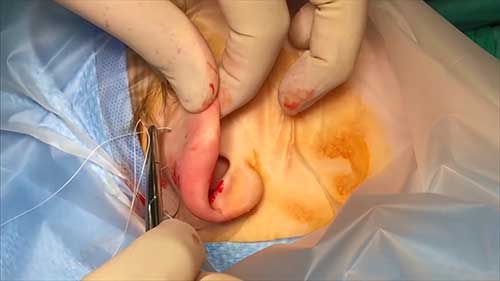 无切口耳成形术基本操作