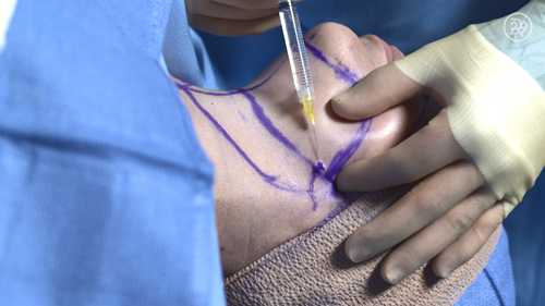 双下巴去除手术