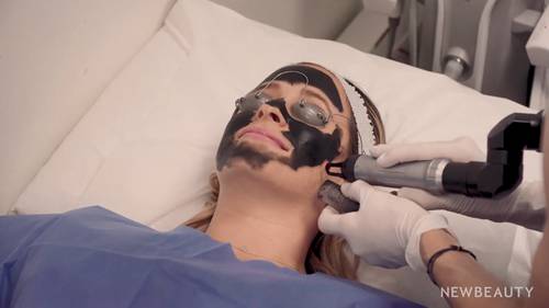 碳激光疗法让皮肤更好