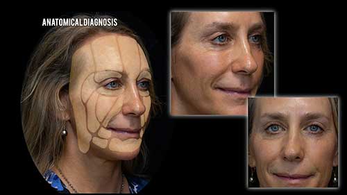 美容脂肪垫解剖