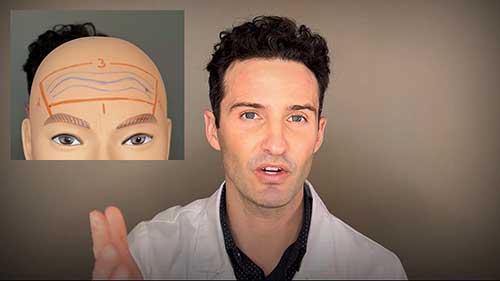 前额除皱注射教程