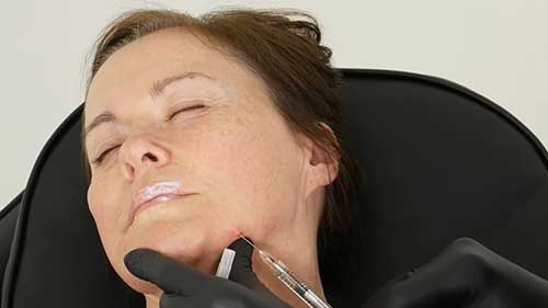 皮下填充技术：下巴和脸颊