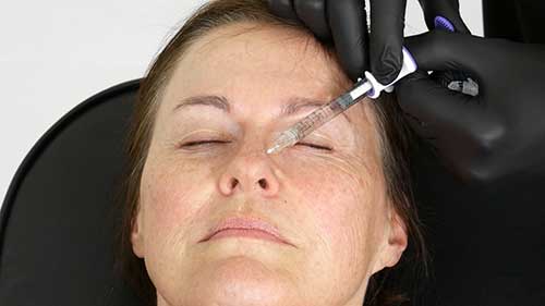 皮下填充技术：鼻唇沟