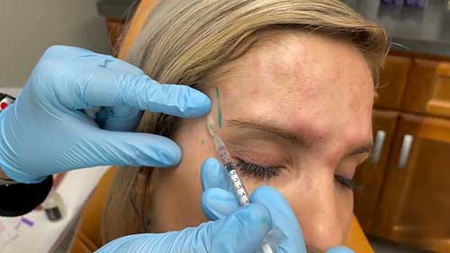 肉毒素注射技术：水平前额皱纹线