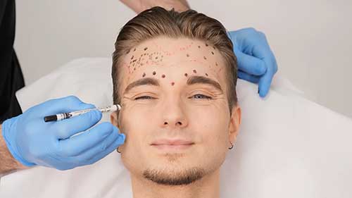 肉毒素除皱适合男性吗