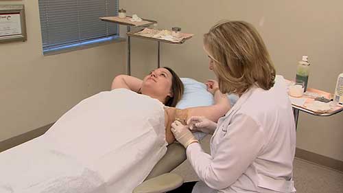 腋下注射肉毒素