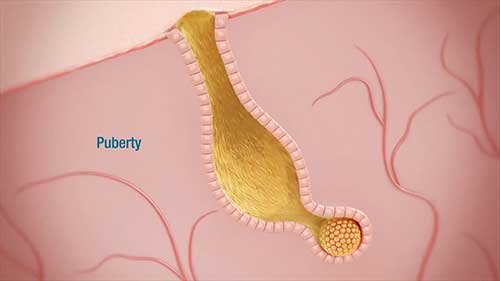 水杨酸剥脱的适应症