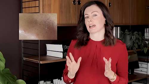 水杨酸剥脱的优缺点