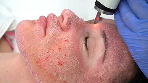 二氧化碳激光面部焕肤