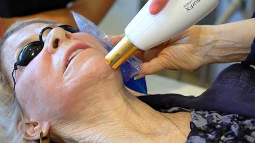 光梭雷射及其适应症